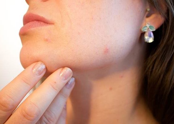 How to get rid of skin red spots