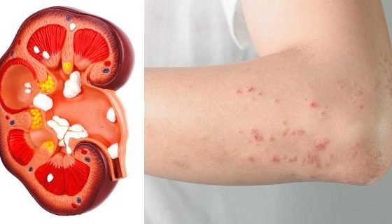If Your Kidney Is in Danger, the Body Will Give You These 8 Signs!