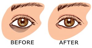 7 Remedies How To Remove Under Eye Dark Circles