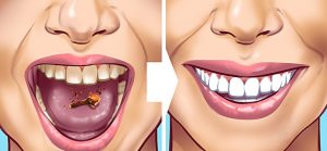 Naturally Whiten Teeth: 10 Ways To Remove Tartar Stains From Your Teeth