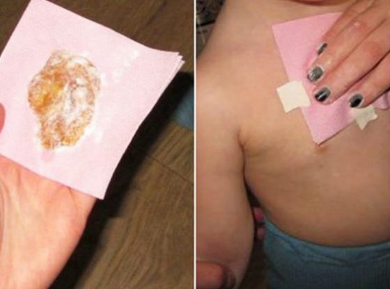 Ginger Wraps – Treats Bad Cough And Removes Mucus From The Lungs in One Night!