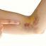How Тo Get Rid Оf Bruises Naturally